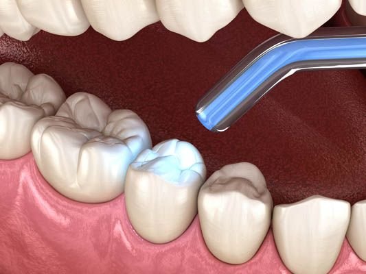Composite Filling