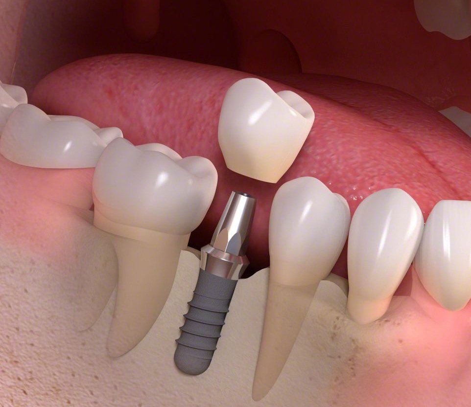Dental Implants