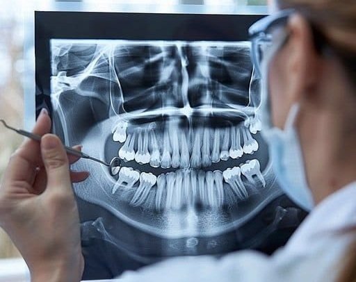 Dental X-Rays