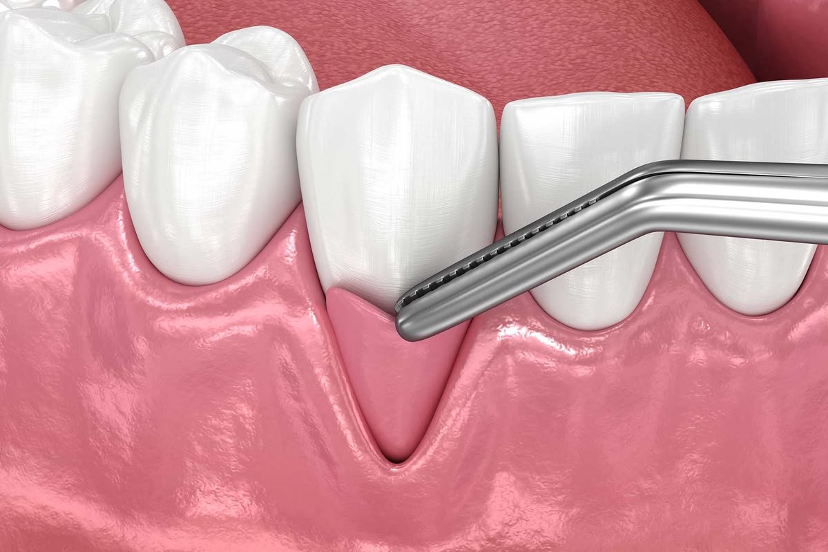 Gum Surgery