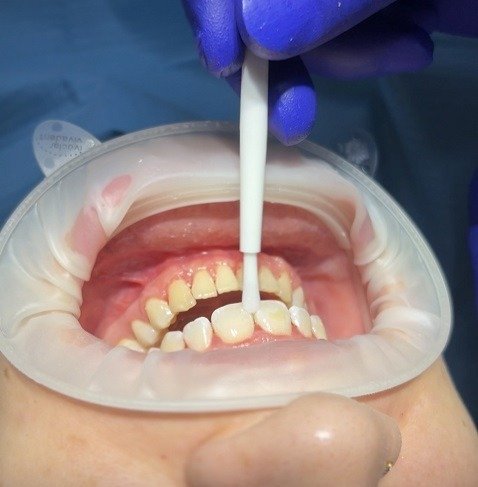 Teeth Whitening